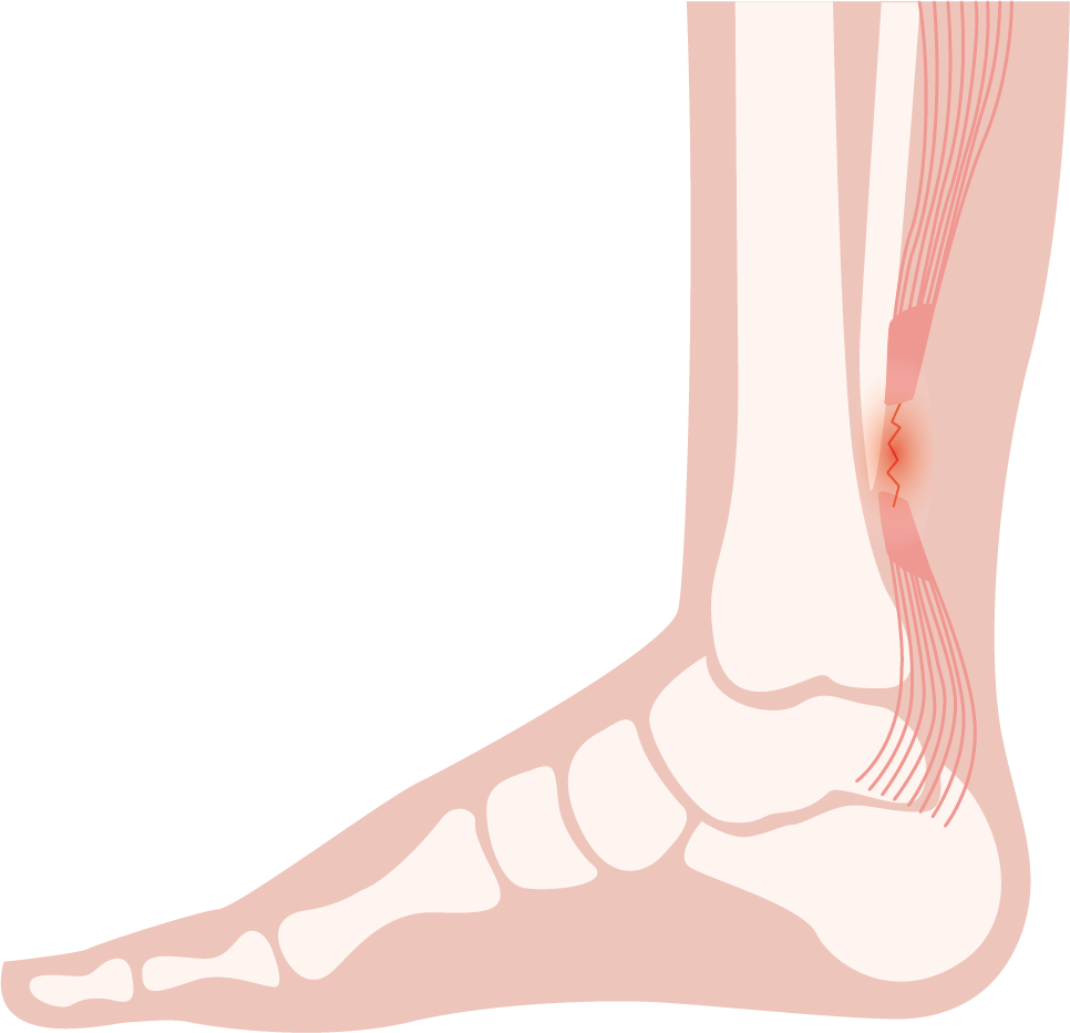 Illustration einer Achillessehnenverletzung am Fuß, relevant für Kuenzli Schuhe.